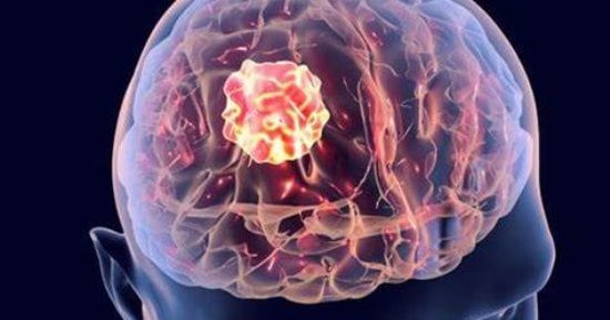 You are currently viewing اليوم العالمي لأورام الدماغ: أهمية الأعراض والتشخيص المبكر