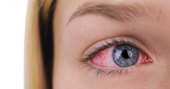You are currently viewing كيفية علاج احمرار العين والتهابها في المنزل أثناء موجة الحر